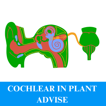 COCHLEAR IN PLANT ADVISE